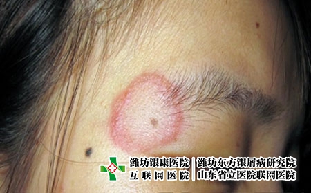 尋常型銀屑病會傳染嗎?得了牛皮癬要注意什么