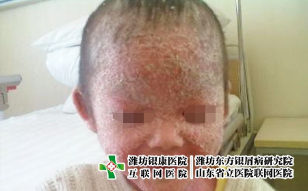 濰坊都有哪些好的牛皮癬醫院，山東哪家銀屑病醫院好