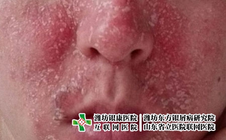 身上的銀屑病治不好是什么原因，牛皮癬為什么不好治