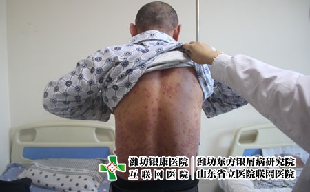 牛皮癬形成的原因，什么會引起銀屑病