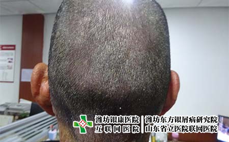 頭皮牛皮癬會出現(xiàn)哪些癥狀,頭上會長銀屑病嗎 頭皮牛皮癬會出現(xiàn)哪些癥狀,頭上會長銀屑病嗎