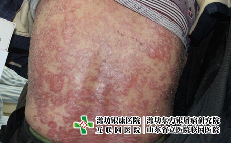 青島牛皮癬哪家治療較好?什么樣的醫(yī)院能治療銀屑病 青島牛皮癬哪家治療較好?什么樣的醫(yī)院能治療銀屑病
