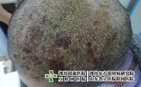 引起頭部牛皮癬的原因是什么，濰坊牛皮癬專科哪家較好?