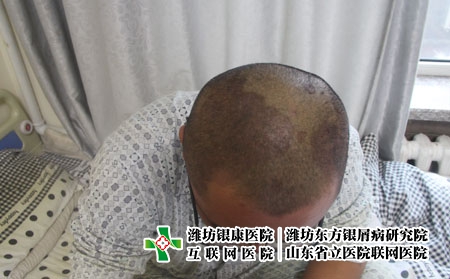 頭部牛皮癬怎么治療好，安丘哪家牛皮癬醫(yī)院較正規(guī)?