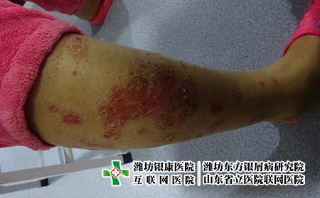 患了銀屑病皮膚干怎么辦，濰坊東方怎么治牛皮癬