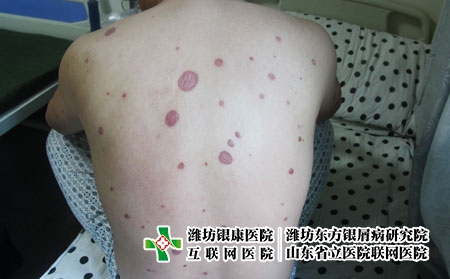 尋常型牛皮癬中藥方有哪些?濰坊好銀屑病專科夸贊東方