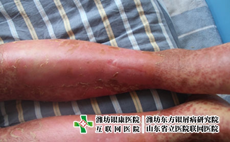 銀屑病要怎么診斷，濟(jì)南治療牛皮癬比較正規(guī)的醫(yī)院?