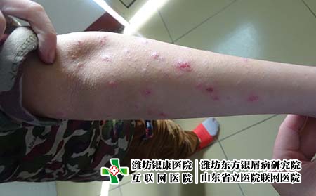 銀屑病患者吃水果的時(shí)候要注意什么