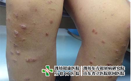 為什么會得銀屑病