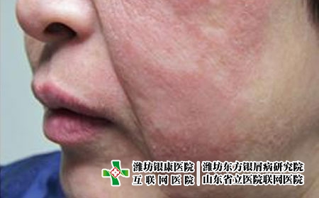 臉部牛皮癬患者要怎么護(hù)理