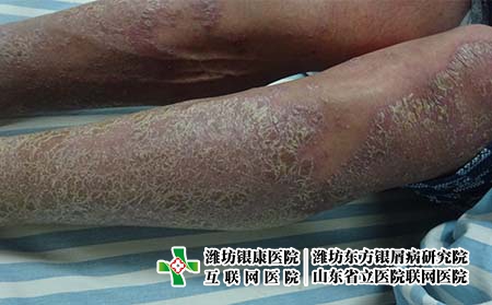 在濟南治療銀屑病要花多少錢