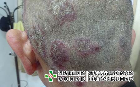 牛皮癬患者要注意哪些預防保健常識 牛皮癬患者要注意哪些預防保健常識