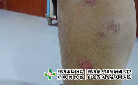 濰坊哪家醫院專門治療牛皮癬