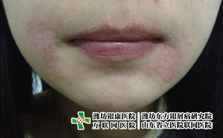 女性臉部銀屑病治療時不能忘記什么 女性臉部銀屑病治療時不能忘記什么