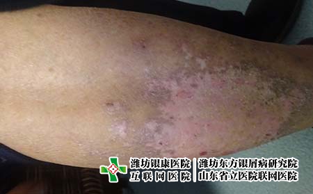 濰坊有哪些好的牛皮癬醫院?