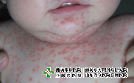 嬰兒患上牛皮癬治療起來困難嗎