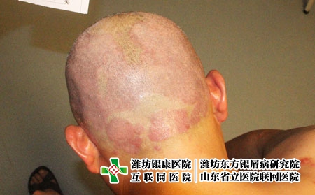 濟南銀屑病醫院怎么樣