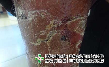 尋常型牛皮癬癥狀有哪些