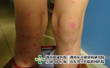 吃蝌蚪能不能治療牛皮癬 吃蝌蚪能不能治療牛皮癬