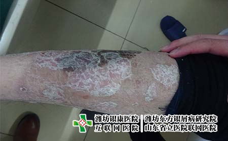 面部出現銀屑病后如何治療