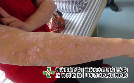 青島專業的銀屑病醫院在哪里