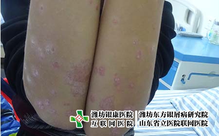 濰坊牛皮癬治療哪里醫院好? 濰坊牛皮癬治療哪里醫院好?