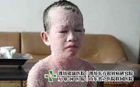 冬季銀屑病怎么控制避免復(fù)發(fā)