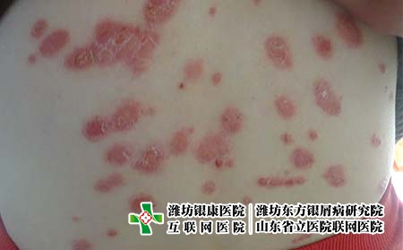 牛皮癬的幾點主要病因