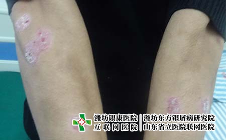 牛皮癬好的治療方法有哪些 牛皮癬好的治療方法有哪些