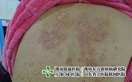 牛皮癬怎么醫治才比較好