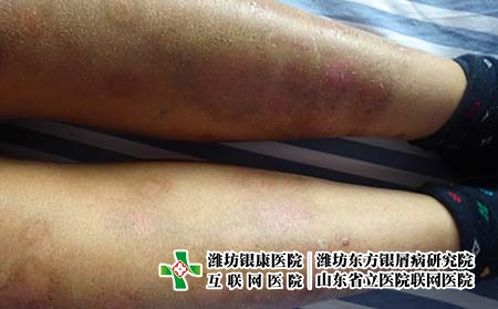 得了牛皮癬能不能常常洗澡