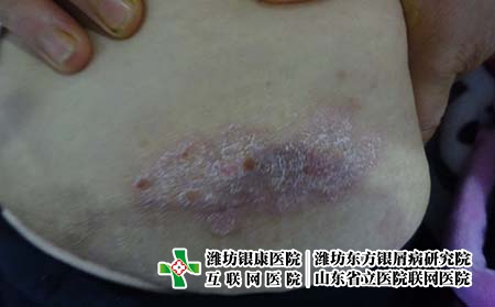 濰坊哪個牛皮癬醫(yī)院比較正規(guī)?