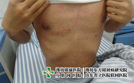 牛皮癬患者如何在日常生活中保護好皮膚