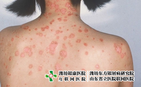 冬季牛皮癬怎樣減少復發的可能?