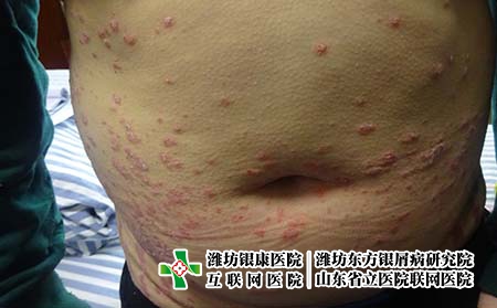 濟(jì)南哪里治銀屑病好 濟(jì)南哪里治銀屑病好