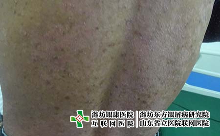 得了點滴銀屑病是怎么回事