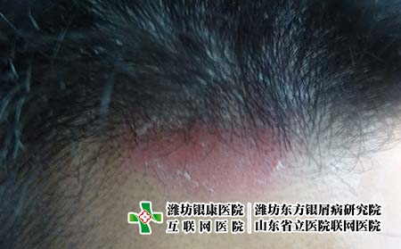 牛皮癬的病因有哪些