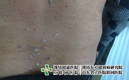 濰坊專業看牛皮癬哪家好