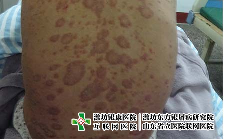 尋常型牛皮癬的癥狀特點有哪些