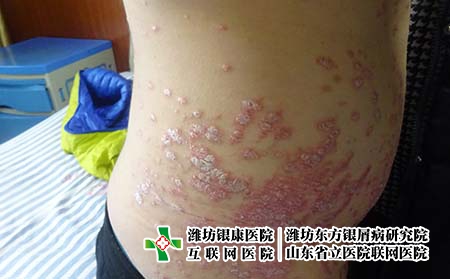 如何輔助治療銀屑病 如何輔助治療銀屑病