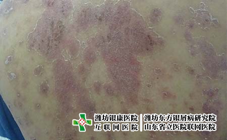 來了濟南哪里治銀屑病好
