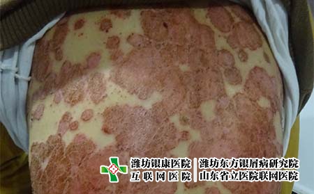 青島哪家醫(yī)院治牛皮癬正規(guī)專業(yè) 青島哪家醫(yī)院治牛皮癬正規(guī)專業(yè)