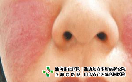 得了尋常型牛皮癬是怎么回事