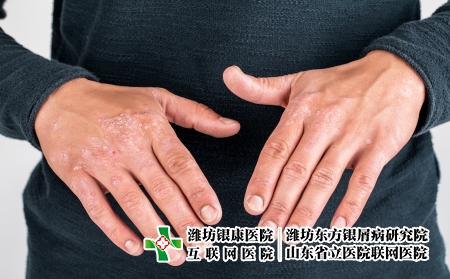 攝圖網(wǎng)_506227449_患有粗俗的牛皮癬濕疹和其他皮膚?。ㄆ髽I(yè)商用）_副本