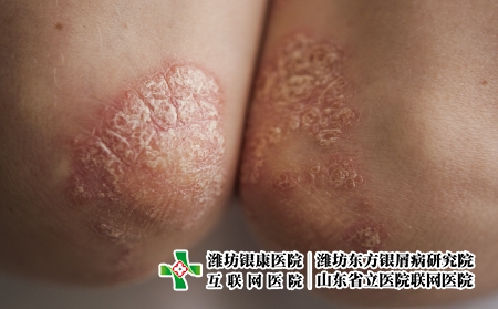 攝圖網(wǎng)_326238053_身穿白色T恤的年輕女子手肘皮膚上的絲蟲病癥狀發(fā)癢皮炎疾病衛(wèi)生保健濕疹皮膚科女性女孩(企業(yè)商用) 攝圖網(wǎng)_326238053_身穿白色T恤的年輕女子手肘皮膚上的絲蟲病癥狀發(fā)癢皮炎疾病衛(wèi)生保健濕疹皮膚科女性女孩(企業(yè)商用)