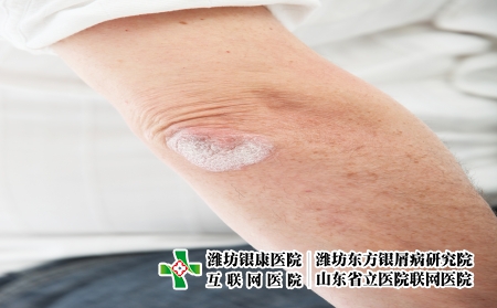 攝圖網_321241037_絲蟲病皮膚或決定肘肘（企業商用） (2)