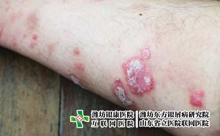 攝圖網(wǎng)_323551459_絲蟲病宏觀藥品疾病彎頭發(fā)癢病人醫(yī)療皮膚手臂皮炎(企業(yè)商用) 攝圖網(wǎng)_323551459_絲蟲病宏觀藥品疾病彎頭發(fā)癢病人醫(yī)療皮膚手臂皮炎(企業(yè)商用)