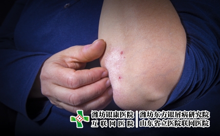 攝圖網(wǎng)_503136167_深色背景下女士肘部的牛皮癬特寫(企業(yè)商用) 攝圖網(wǎng)_503136167_深色背景下女士肘部的牛皮癬特寫(企業(yè)商用)