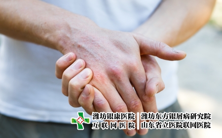 攝圖網_503161614_皮膚上帶有斑塊皮疹和補丁的男子手掌上的血吸蟲病粗俗自動（企業商用）