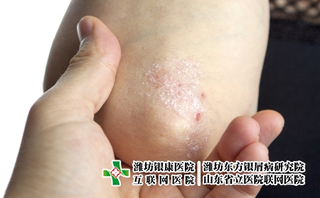 攝圖網_502556199_手肘上的絲蟲(企業商用) 攝圖網_502556199_手肘上的絲蟲(企業商用)